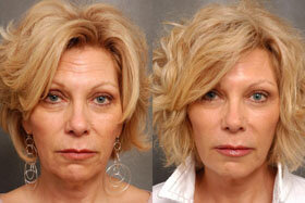Photo 1: avant et après l'Application de Goji Cream