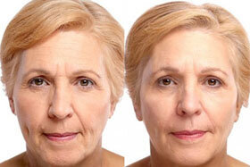 Photo 3: avant et après l'Application de Goji Cream