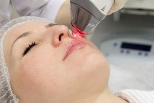 Processus de rajeunissement de la peau du visage au laser fractionné
