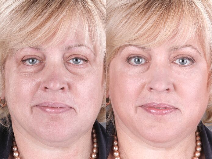 avant et après avoir utilisé le masseur pour rajeunir ltza photo 3