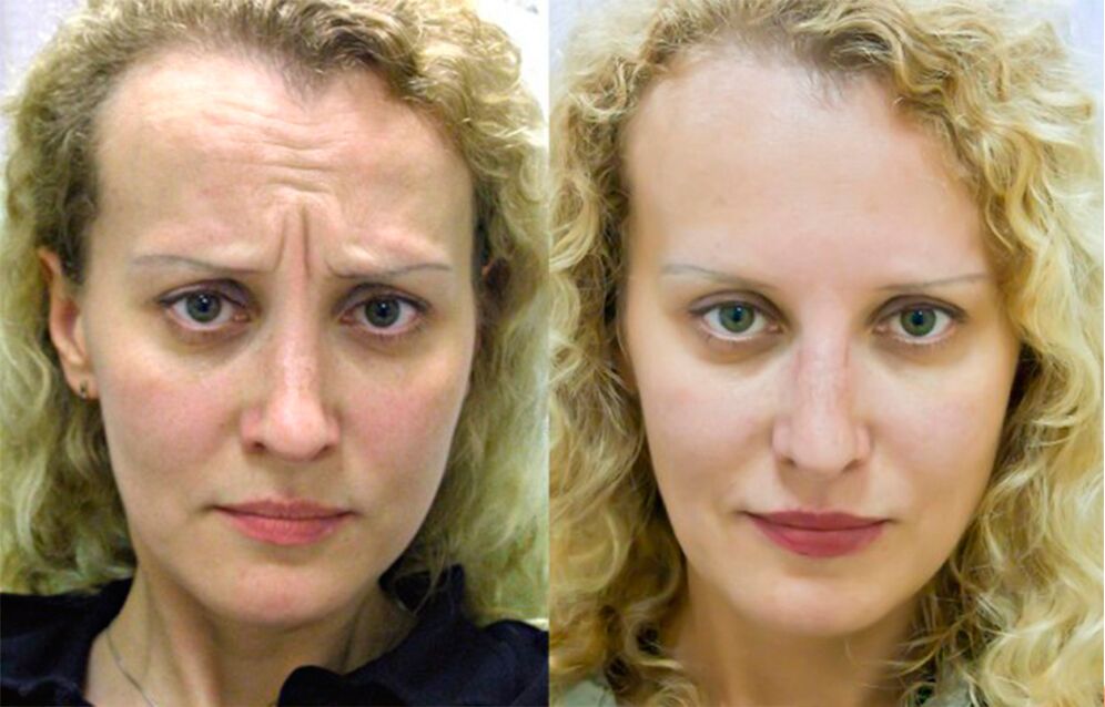 avant et après l'utilisation du masseur de rajeunissement ltza photo 1