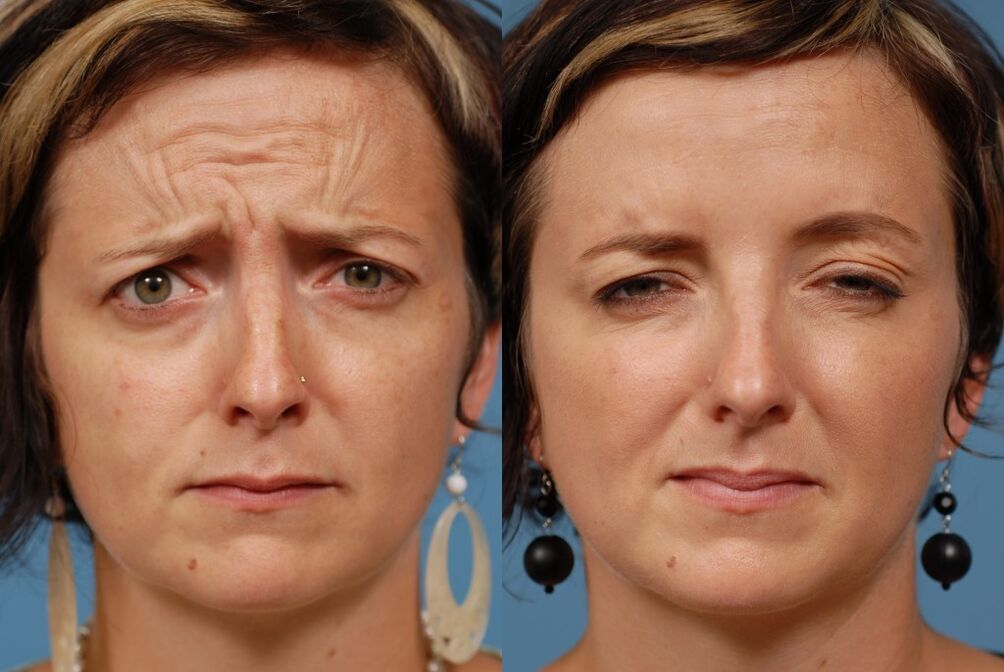 avant et après l'utilisation du masseur de rajeunissement ltza photo 2