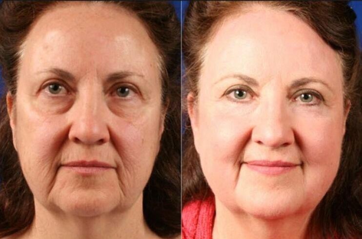 avant et après l'utilisation du masseur de rajeunissement ltza photo 6