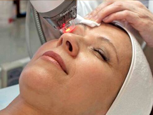 resurfaçage au laser de la peau autour des yeux