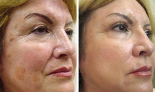Rajeunissement fractionnel de la peau avant et après les photos