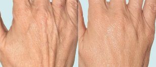 Peau des mains avant et après la thérapie fractionnée. 
